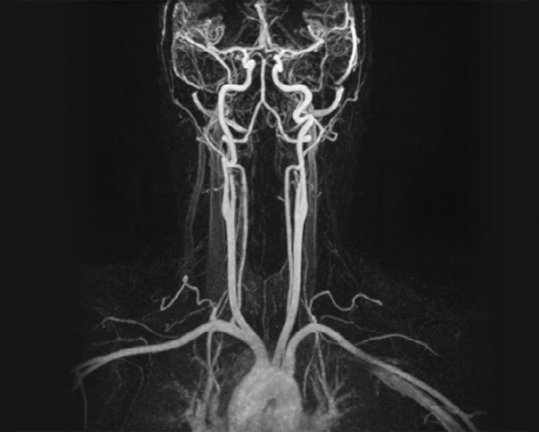 MRT der Gefäße (MR-Angiographie)
